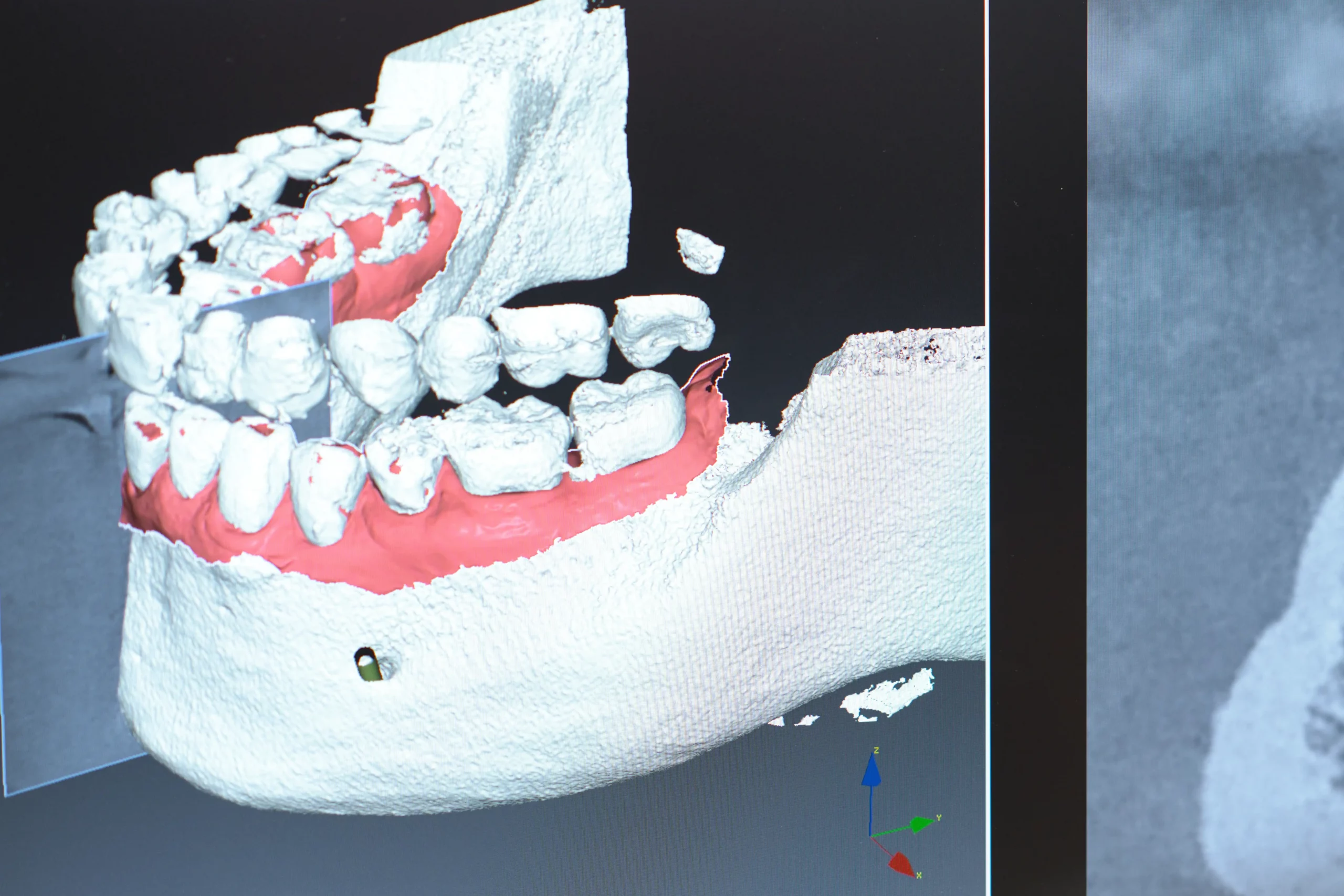 3D-Diagnostik für die Implantatplanung Digitale 3D-Planung von Zahnimplantaten und Zahnersatz